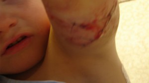 wolf hybrid attack injuries